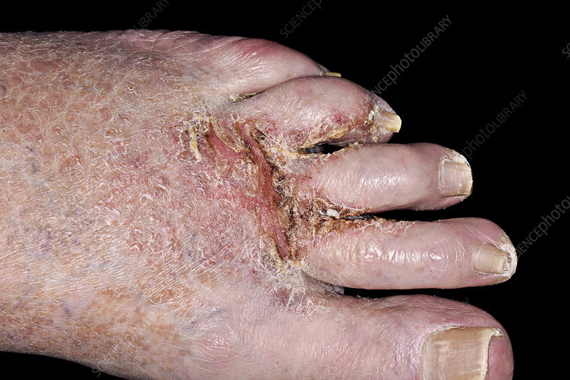Not to be used for advertising or in a defamatory context  
Ringworm and secondary bacterial infection of the foot. This is a case of a chronic fungal skin infection on the left foot of an 80-year-old man. Known as ringworm, and also called athlete's foot or tinea pedis, this is a dermatophyte infection caused by a fungus. It is highly contagious and is spread by direct contact or via infected material. It is treated by application of an antifungal agent. Secondary bacterial infections occur following an initial infection, and are treated with antibiotics.