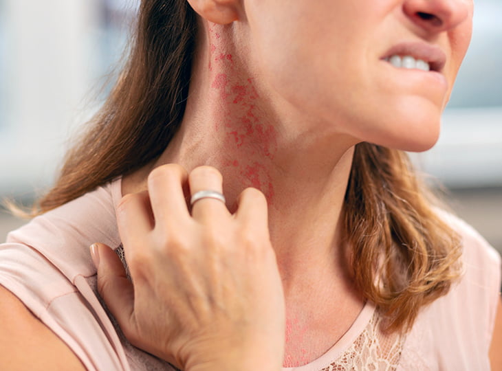 Ring on finger. Blond woman wearing ring on finger having rash on neck because of allergy