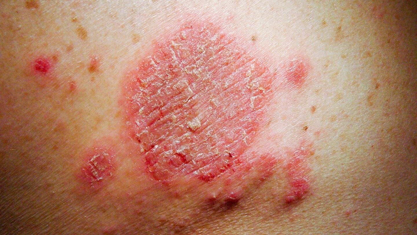 whats-causing-your-skin-rash-10-rm-1440x810